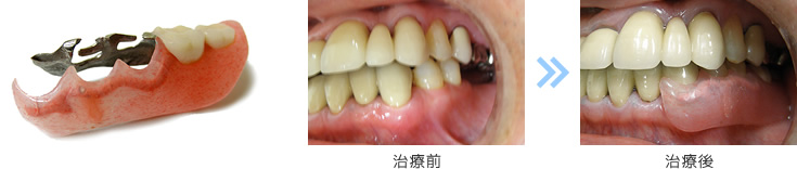 入れ歯症例 2 治療前後比較写真